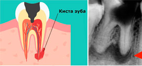 Лечение кисты зуба народными средствами