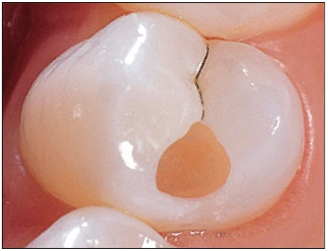 Повторное нанесение Sable Seek и повторная промывка обработанного участка Повторное нанесение Sable Seek и повторная промывка обработанного участка.webp
