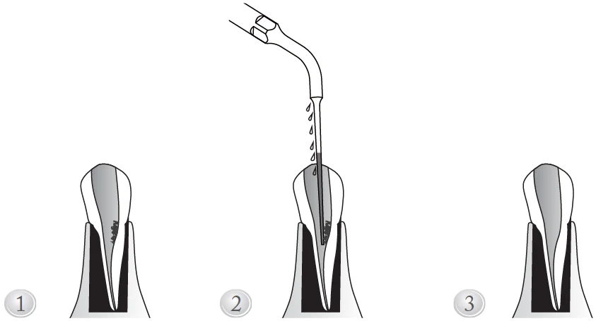 Применение насадки ED14D.webp