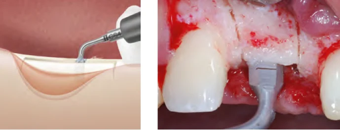 Насадка CS4 Crest Splitting применение.webp