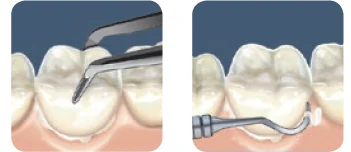 Установка реставрации после нанесения цемента Nexus RMGI Установка реставрации после нанесения цемента Nexus RMGI.webp
