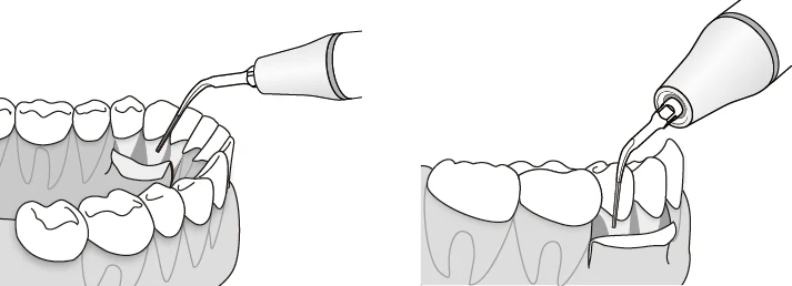 Применение насадки P3D.WEBP