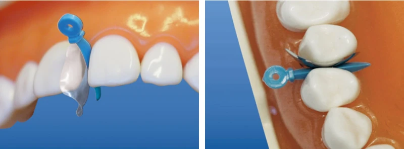 Пример установки клиньев фиксирующих изолирующих от компании ТОР ВМ.webp