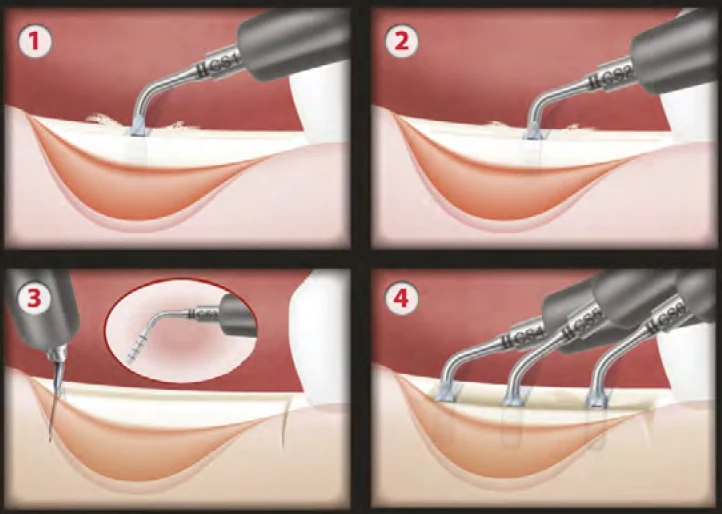 Насадки Crest Splitting порядок работы.webp
