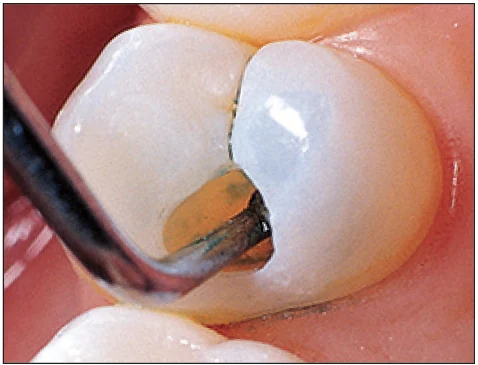 Удаление подкрашенного Sable Seek кариозного дентина Удаление подкрашенного Sable Seek кариозного дентина.webp