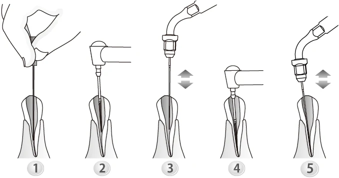 Применение насадки E1.webp