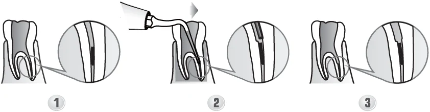 Применение насадки ED3D.webp