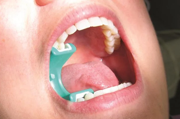 Пример правильной установки LogiBloc в полости рта пациента.webp