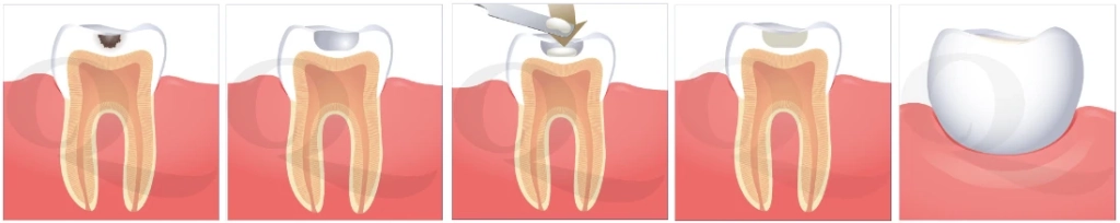 Everest IX применение.webp