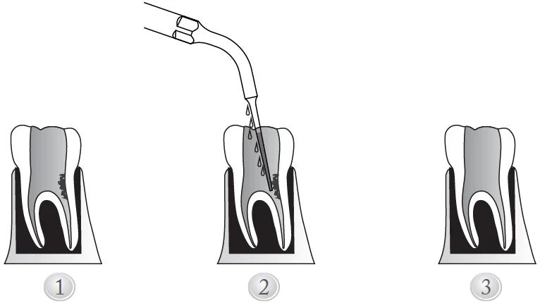 Применение насадки E15D.WEBP