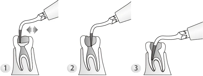 Применение насадки P4D.webp