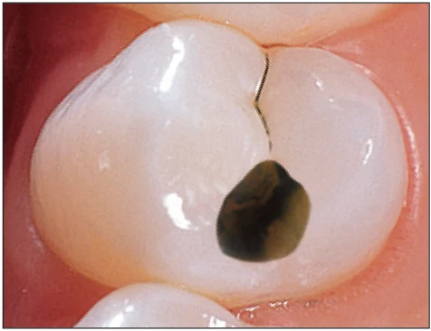 Промывка, используя струю воздуха воды и аспирацию Промывка, используя струю воздуха воды и аспирацию.webp