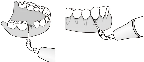 Применение насадки ED8 с борами для зубных имплантатов.webp