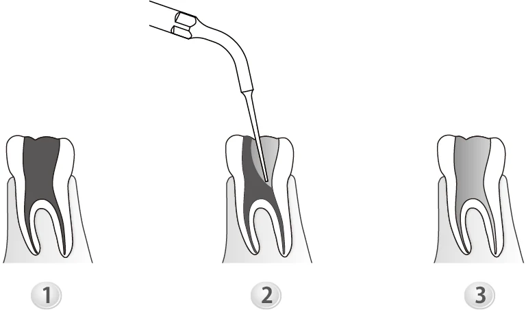 Применение насадки E5.webp