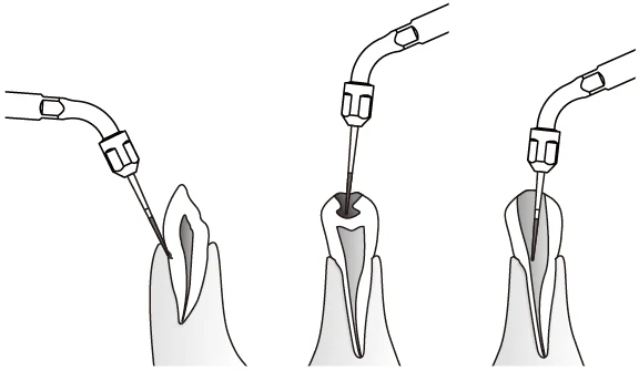 Применение насадки ED8 с борами.webp