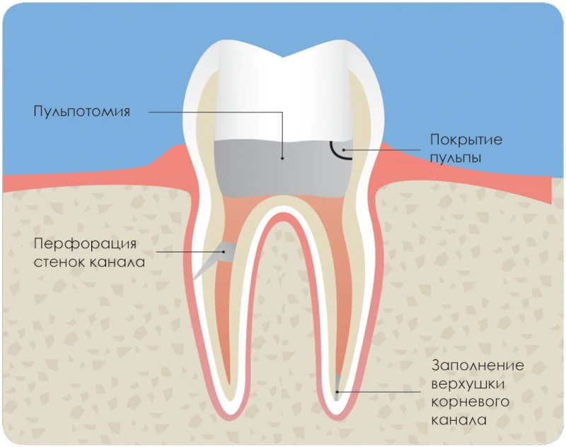 Diadent Dia-Root Bio MTA показания к применению.webp