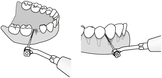 Применение насадки ED9 с борами для зубных имплантатов.webp