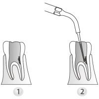 насадка ed5d к скайлеру, эндодонтическая (подходит к dte, satelec, nsk) для уплотн.гуттап., woodpeck