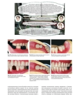 стандарт полного съёмного зубного протеза. автор: накагоми тасио