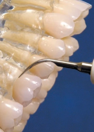 насадка №1 для скалера для удаления зубного камня, acteon