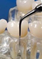 насадка h2l для скалера satelec пародонтологическая с алмазным напылением (f00367) acteon