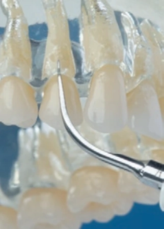 насадка 1s для скалера пародонтологическая, acteon