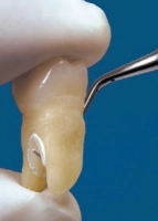 насадка h2r для скалера satelec пародонтологическая с алмазным напылением (f00368) acteon