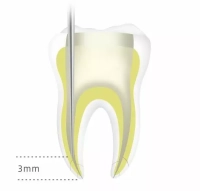 обтуратор гуттаперчи (инжектор) fi-g dte