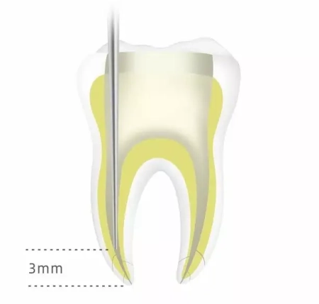 обтуратор гуттаперчи (инжектор) fi-g dte