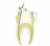 обтуратор гуттаперчи (термоплаггер) fi-p dte