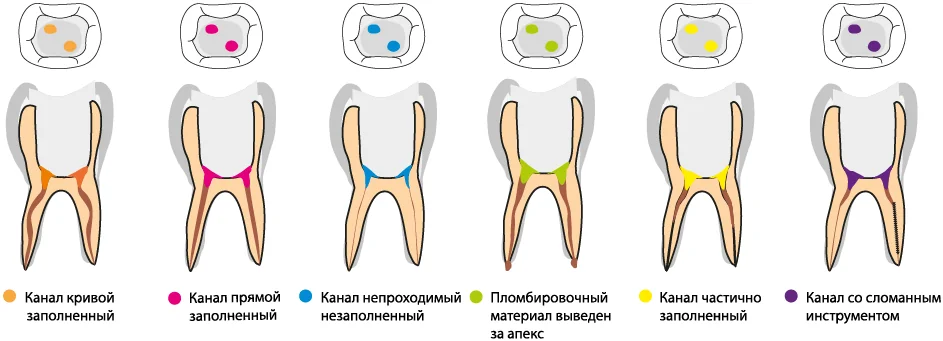 Маркировка при запечатывании устьев каналов Маркировка при запечатывании устьев каналов.webp